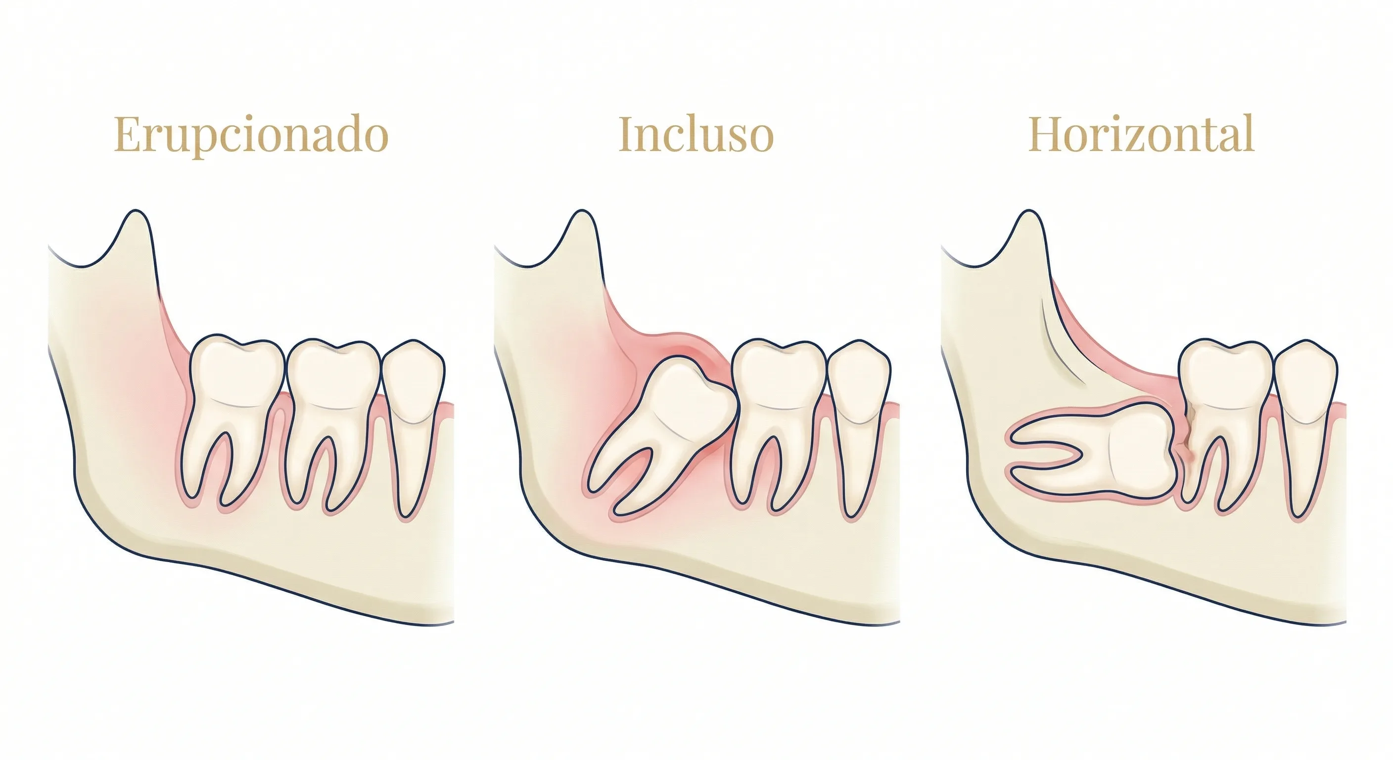 infográfico do ciclo acúmulo de bactérias → inflamação → infecção → complicação.